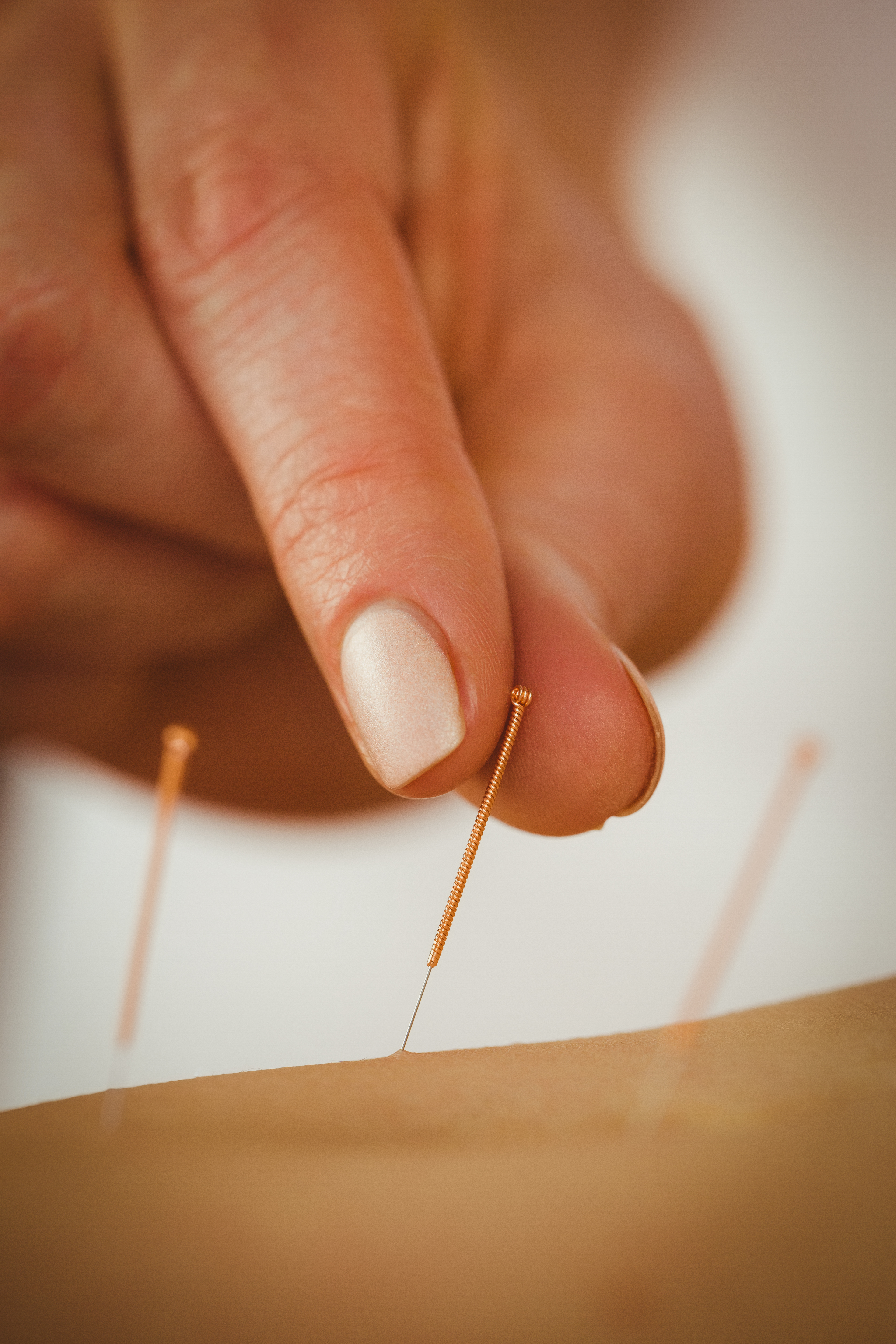 Young woman getting acupuncture treatment in therapy room